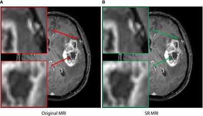 A hybrid deep learning scheme for MRI-based preliminary multiclassification diagnosis of primary brain tumors